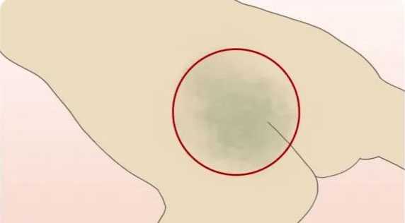 为什么婴儿屁股上有“淤青”? 为什么婴儿屁股上有“淤青”?