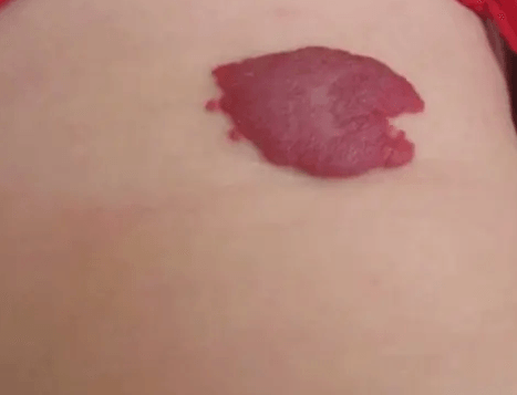 昆明协大皮肤病医院:婴儿血管瘤好治吗? 昆明协大皮肤病医院:婴儿血管瘤好治吗?