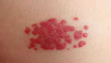 血管瘤治疗之后会复发吗? 血管瘤治疗之后会复发吗?